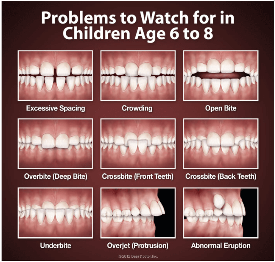 Dental Braces - an overview