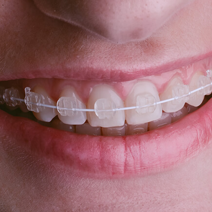 Ceramic Braces, Burnie, The Orthodontic Specialists, Devonport