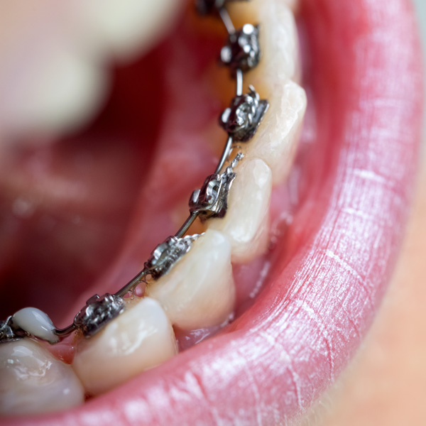 Braces