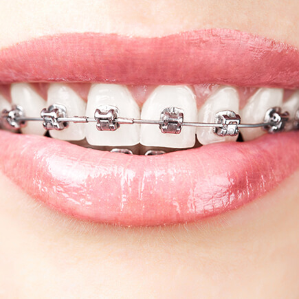 Dental Braces - an overview