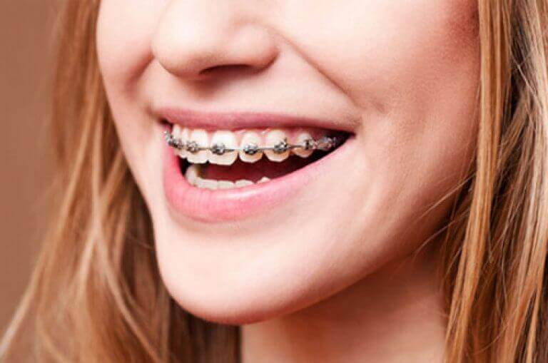Why You Should Wear Your Retainer After Braces.