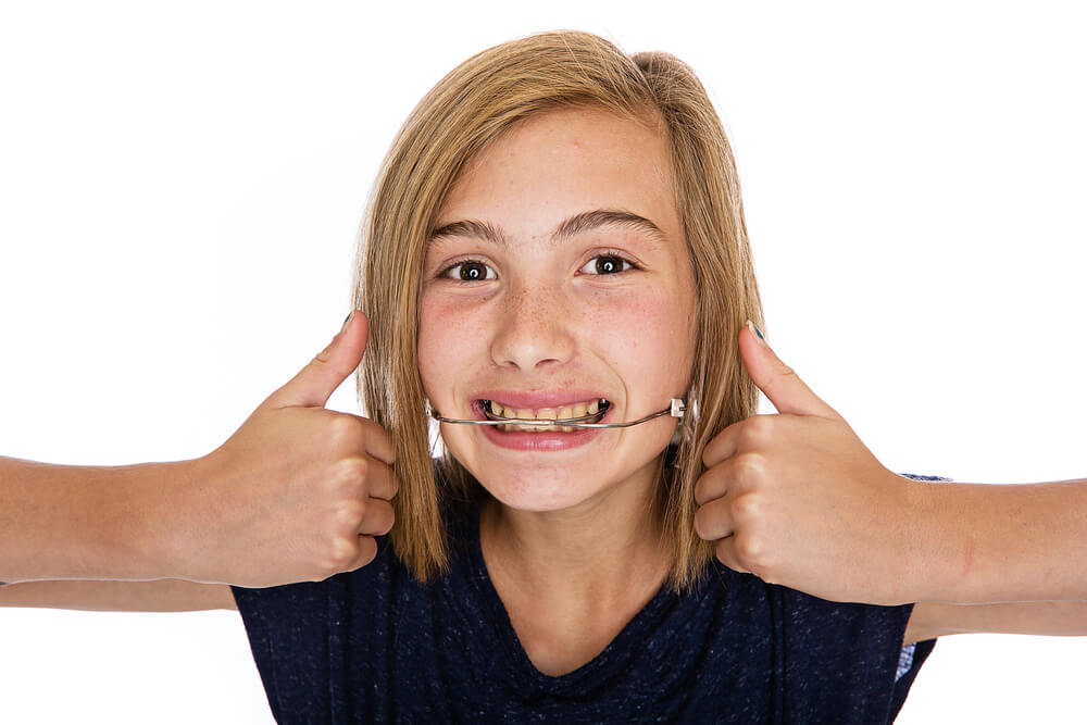 What is Orthodontic Headgear?